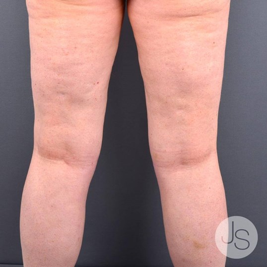 Liposuction (Smooth Lipo) Before and After Pictures Beverly Hills, CA