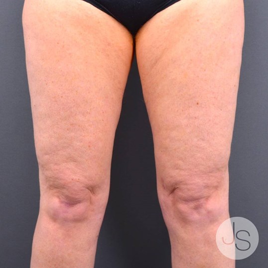 Liposuction (Smooth Lipo) Before and After Pictures Beverly Hills, CA