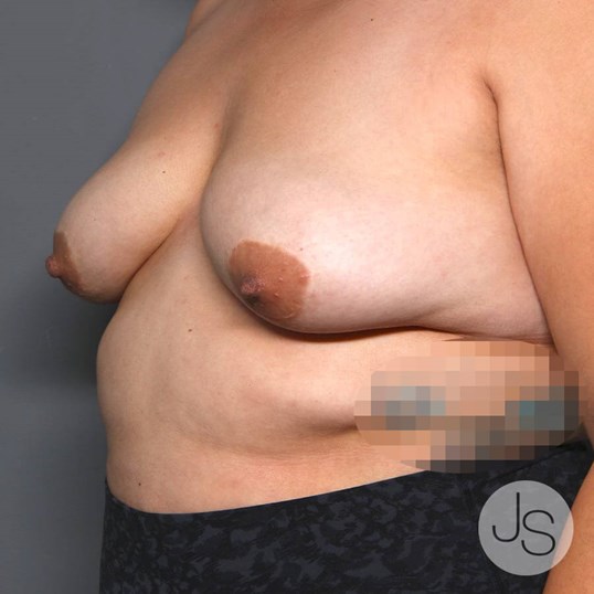 Breast Implant Removal Before and After Pictures Beverly Hills, CA