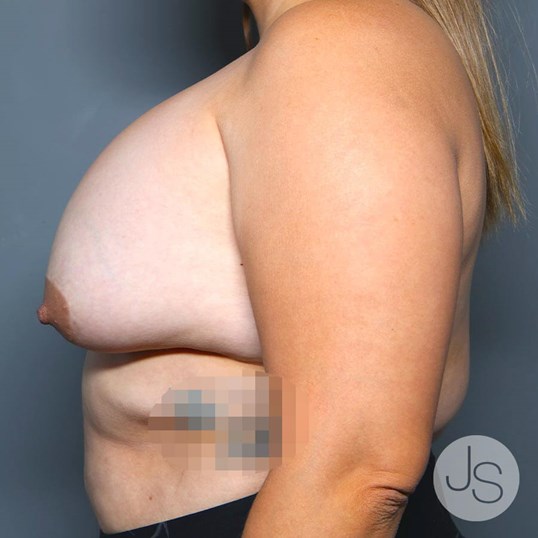 Breast Implant Removal Before and After Pictures Beverly Hills, CA