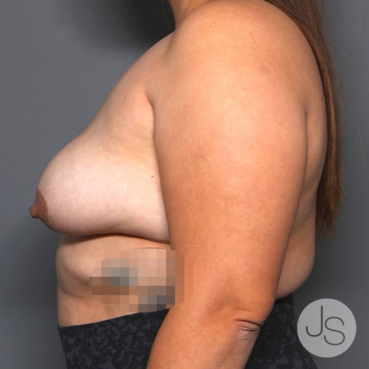 Breast Implant Removal Before and After Pictures Beverly Hills, CA