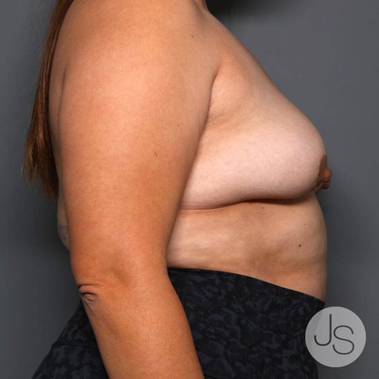 Breast Implant Removal Before and After Pictures Beverly Hills, CA