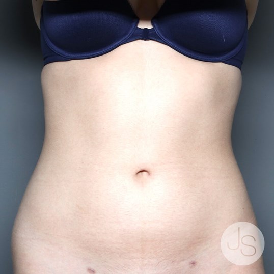 Liposuction (Smooth Lipo) Before and After Pictures Beverly Hills, CA