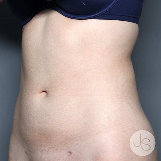 Liposuction (Smooth Lipo) Before and After Pictures Beverly Hills, CA