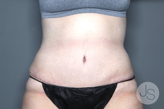 Tummy Tuck Before and After Pictures Beverly Hills, CA