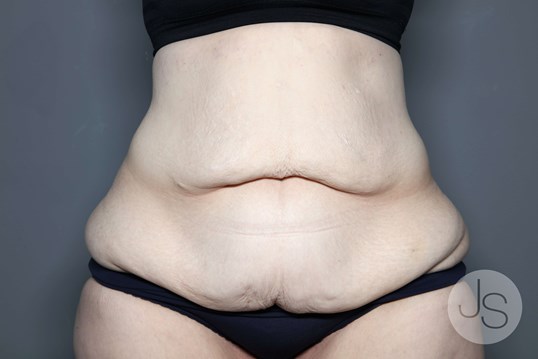 Tummy Tuck Before and After Pictures Beverly Hills, CA