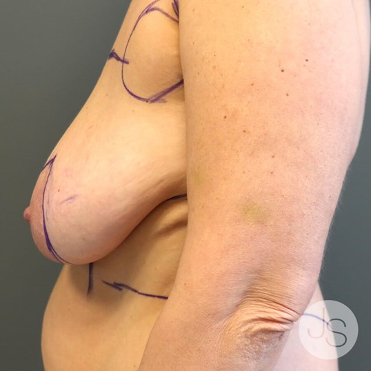 Breast Lift Before and After Pictures Beverly Hills, CA