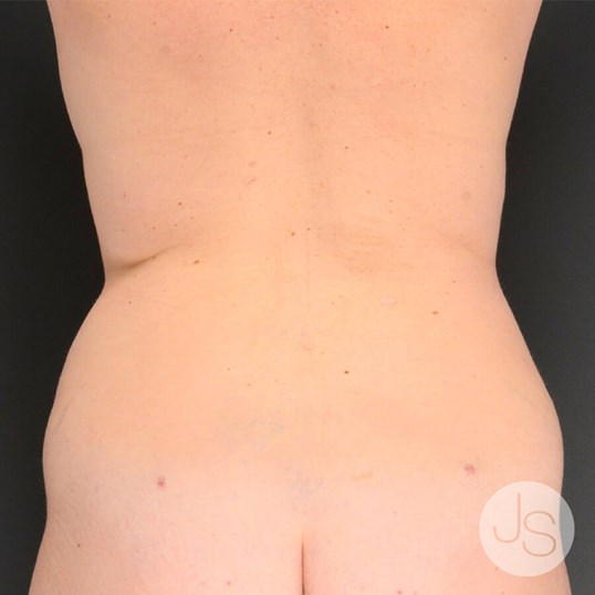 Tummy Tuck Before and After Pictures Beverly Hills, CA