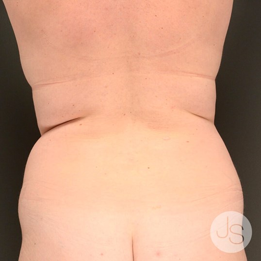 Tummy Tuck Before and After Pictures Beverly Hills, CA