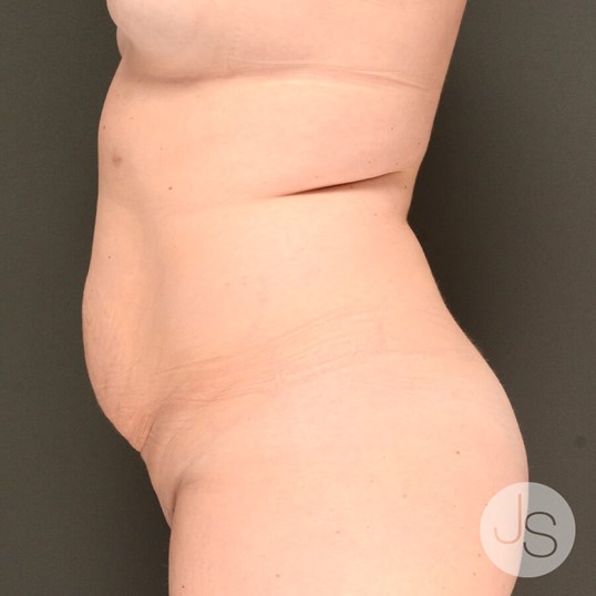 Tummy Tuck Before and After Pictures Beverly Hills, CA