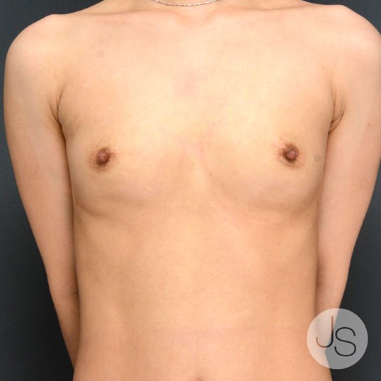 Breast Reconstruction Before and After Pictures Beverly Hills, CA