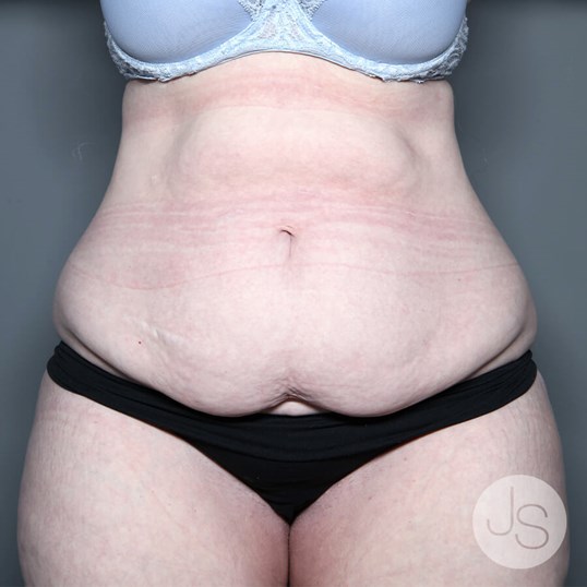 Tummy Tuck Before and After Pictures Beverly Hills, CA