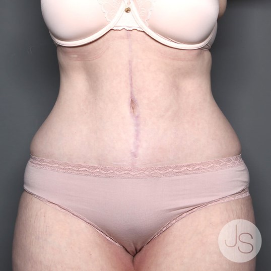 After Weight Loss Surgery Before and After Pictures Beverly Hills, CA