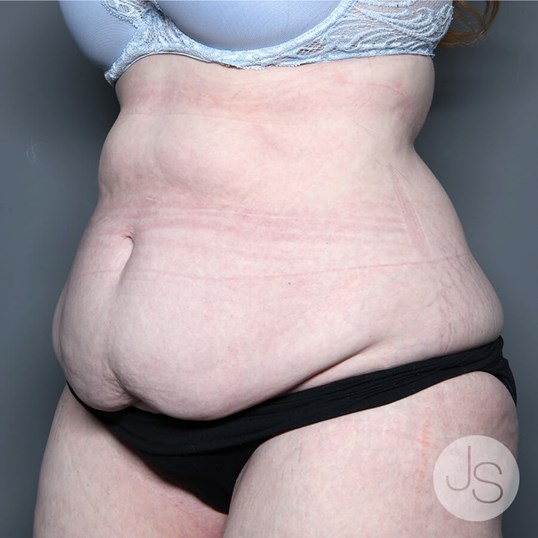 Tummy Tuck Before and After Pictures Beverly Hills, CA