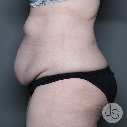 After Weight Loss Surgery Before and After Pictures Beverly Hills, CA