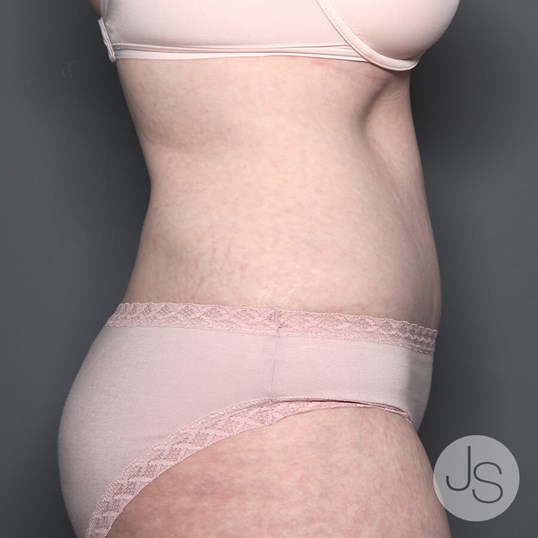 Tummy Tuck Before and After Pictures Beverly Hills, CA