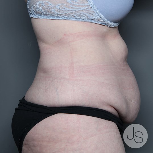 After Weight Loss Surgery Before and After Pictures Beverly Hills, CA