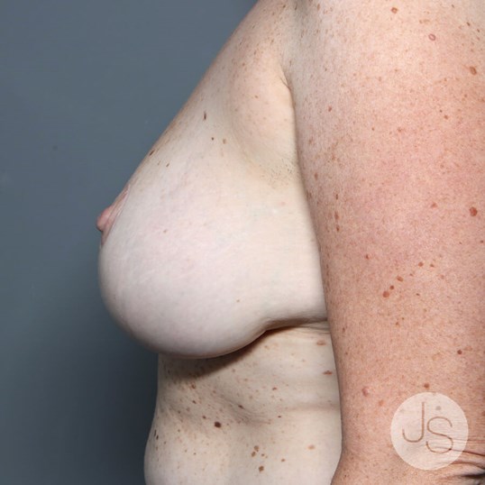 Breast Reduction Before and After Pictures Beverly Hills, CA