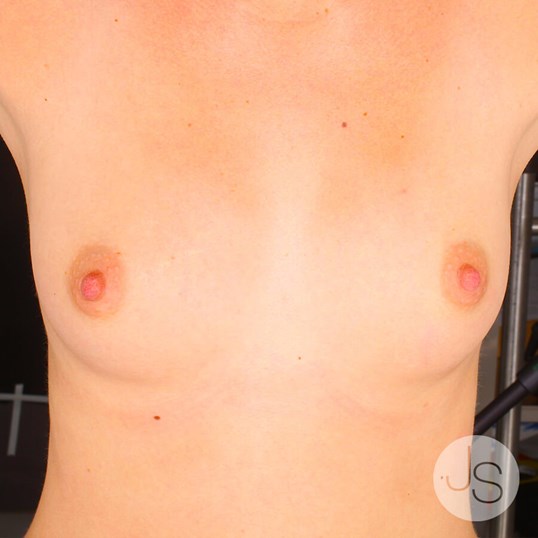 Breast Augmentation Before and After Pictures Beverly Hills, CA