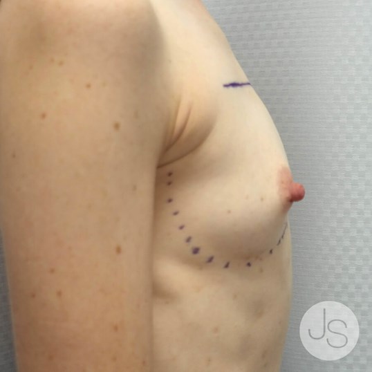 Breast Augmentation Before and After Pictures Beverly Hills, CA