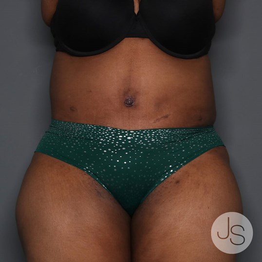 Tummy Tuck Before and After Pictures Beverly Hills, CA