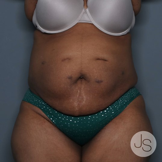 Liposuction (Smooth Lipo) Before and After Pictures Beverly Hills, CA