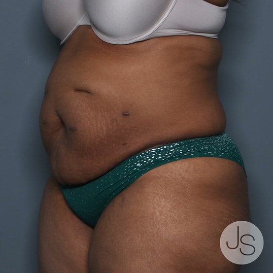 Tummy Tuck Before and After Pictures Beverly Hills, CA