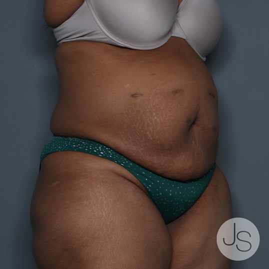 After Weight Loss Surgery Before and After Pictures Beverly Hills, CA