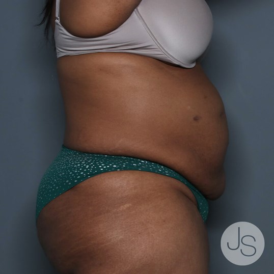 Liposuction (Smooth Lipo) Before and After Pictures Beverly Hills, CA