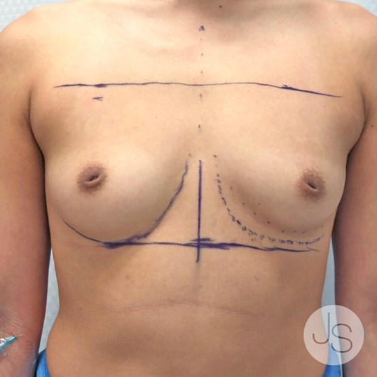 Breast Augmentation Before and After Pictures Beverly Hills, CA