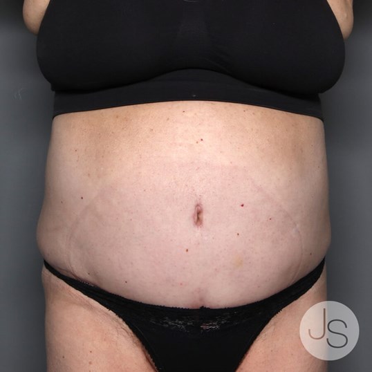 Tummy Tuck Before and After Pictures Beverly Hills, CA