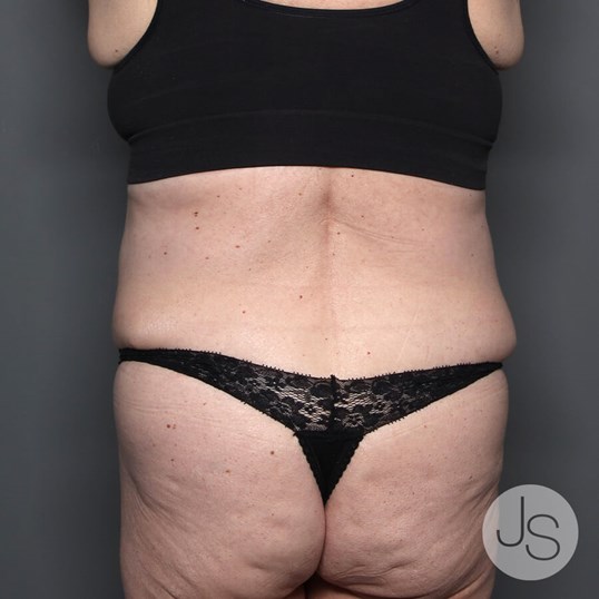 Tummy Tuck Before and After Pictures Beverly Hills, CA