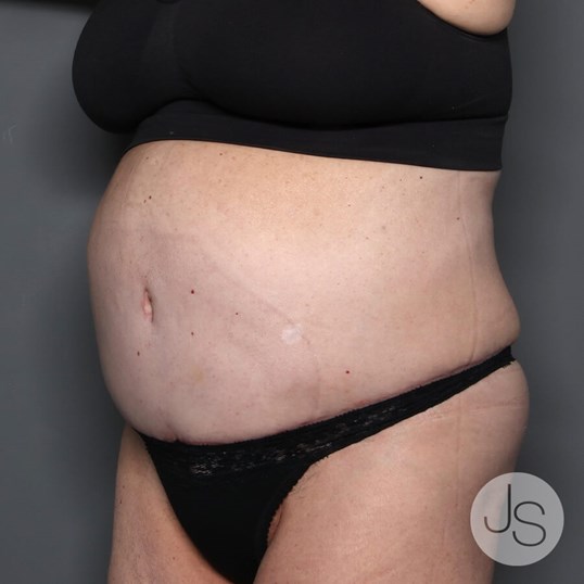 Tummy Tuck Before and After Pictures Beverly Hills, CA