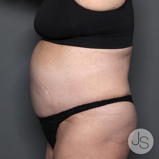 Tummy Tuck Before and After Pictures Beverly Hills, CA