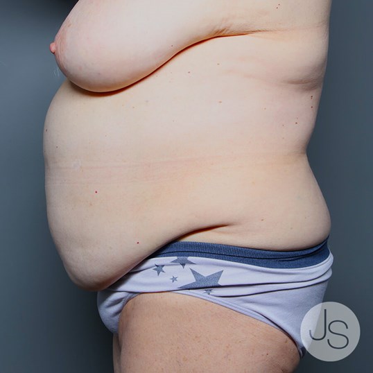 Tummy Tuck Before and After Pictures Beverly Hills, CA