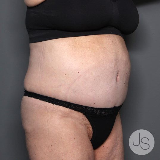 Tummy Tuck Before and After Pictures Beverly Hills, CA