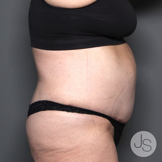 Tummy Tuck Before and After Pictures Beverly Hills, CA