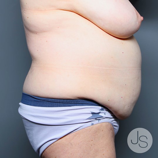 Tummy Tuck Before and After Pictures Beverly Hills, CA