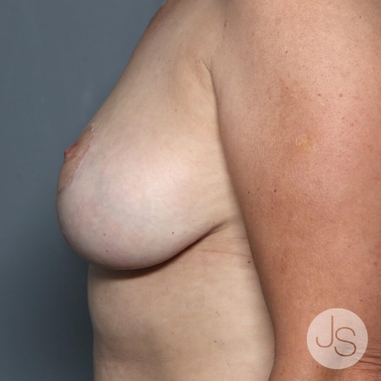 Breast Reduction Before and After Pictures Beverly Hills, CA