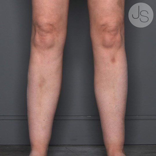 Liposuction (Smooth Lipo) Before and After Pictures Beverly Hills, CA