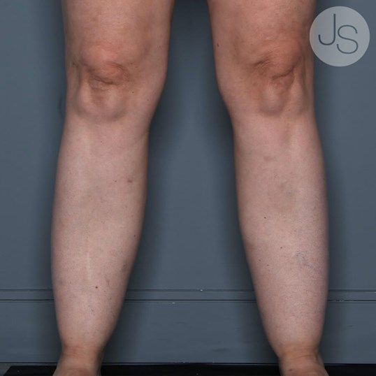 Liposuction (Smooth Lipo) Before and After Pictures Beverly Hills, CA