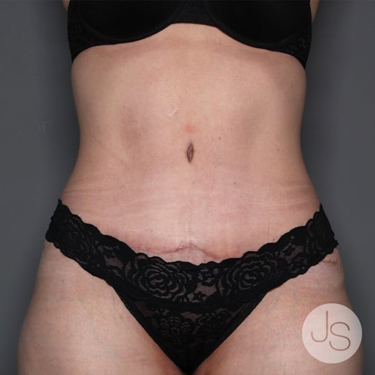 Tummy Tuck Before and After Pictures Beverly Hills, CA