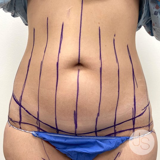 Tummy Tuck Before and After Pictures Beverly Hills, CA