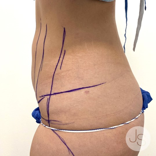 Tummy Tuck Before and After Pictures Beverly Hills, CA