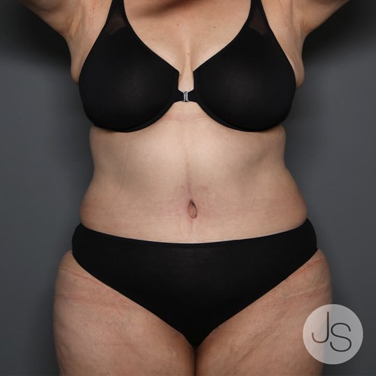 Tummy Tuck Before and After Pictures Beverly Hills, CA