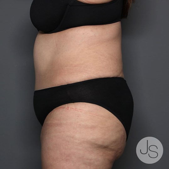 Tummy Tuck Before and After Pictures Beverly Hills, CA