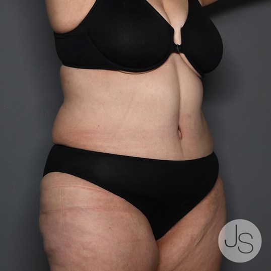 After Weight Loss Surgery Before and After Pictures Beverly Hills, CA