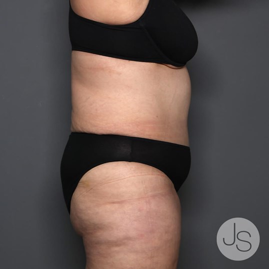 Tummy Tuck Before and After Pictures Beverly Hills, CA