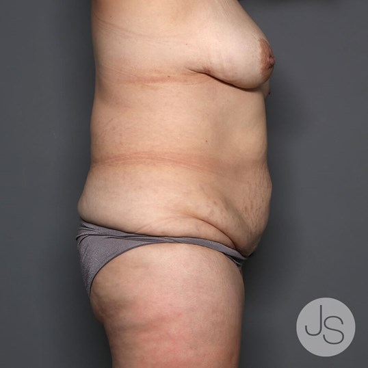 Tummy Tuck Before and After Pictures Beverly Hills, CA