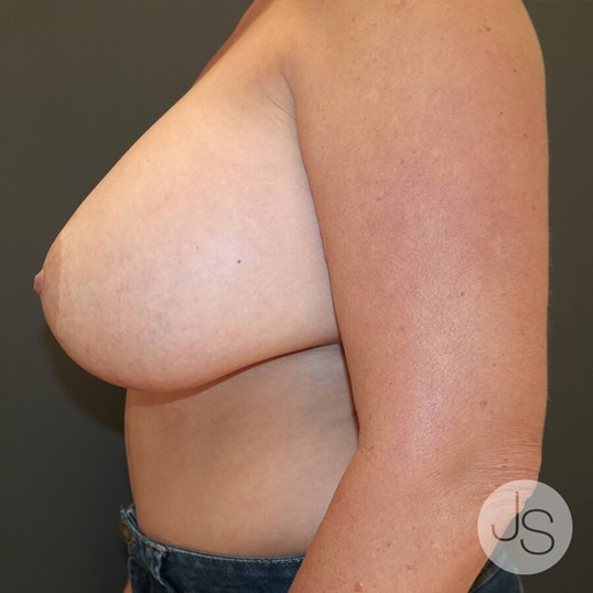 Breast Implant Removal Before and After Pictures Beverly Hills, CA